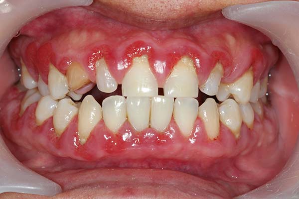 no healthy gums